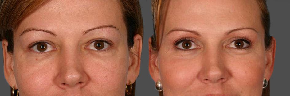 Eyelid Surgery (Blepharoplasty) Before & After Gallery - Patient 334441 - Image 2