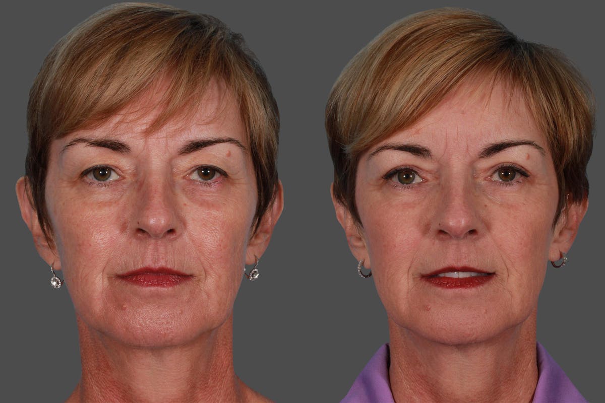 Eyelid Surgery (Blepharoplasty) Before & After Gallery - Patient 152886 - Image 1
