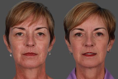 Eyelid Surgery (Blepharoplasty) Before & After Gallery - Patient 152886 - Image 1