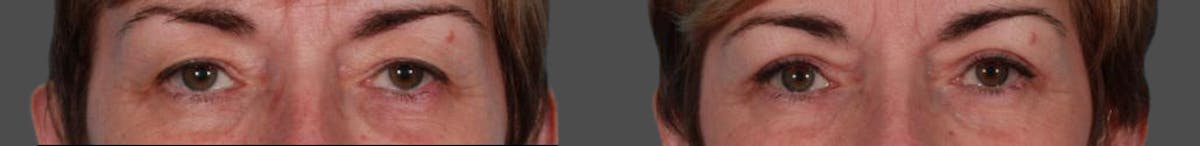Eyelid Surgery (Blepharoplasty) Before & After Gallery - Patient 152886 - Image 2