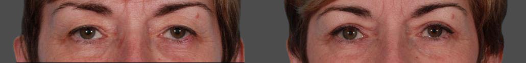 Eyelid Surgery (Blepharoplasty) Before & After Gallery - Patient 152886 - Image 2