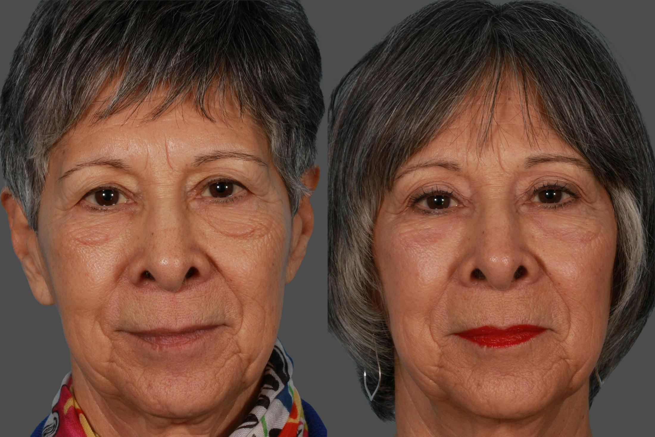 Eyelid Surgery (Blepharoplasty) Before & After Gallery - Patient 130328 - Image 1
