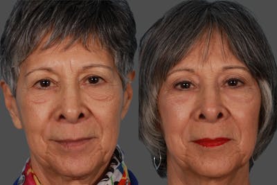 Eyelid Surgery (Blepharoplasty) Before & After Gallery - Patient 130328 - Image 1