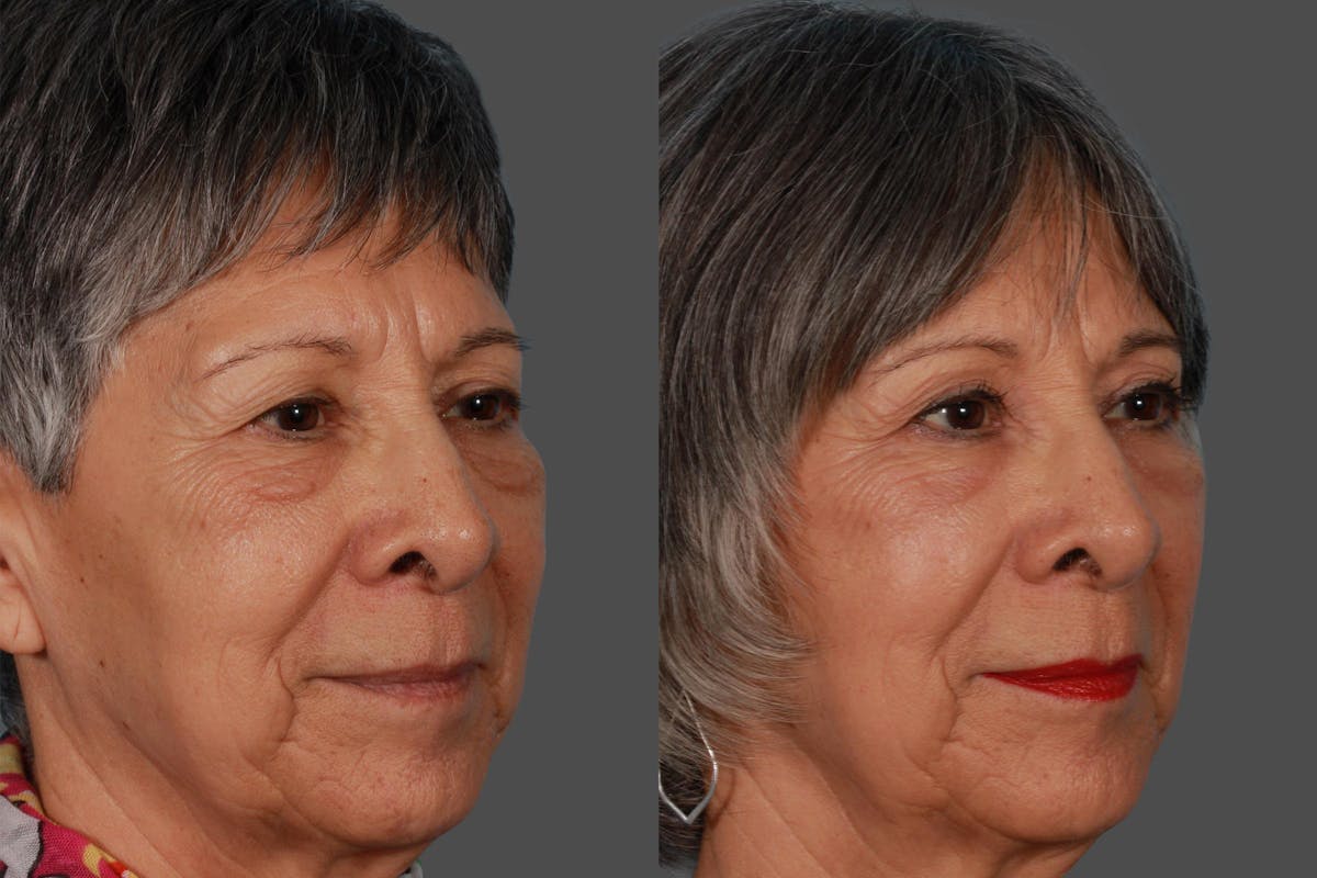 Eyelid Surgery (Blepharoplasty) Before & After Gallery - Patient 130328 - Image 2