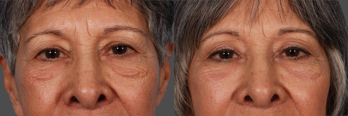 Eyelid Surgery (Blepharoplasty) Before & After Gallery - Patient 130328 - Image 3
