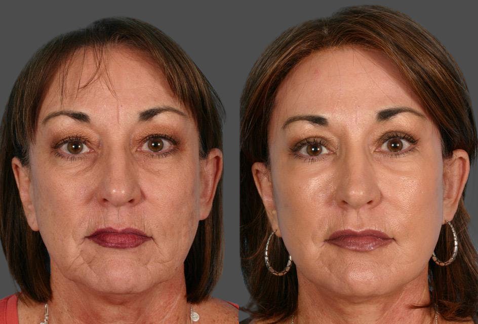 Eyelid Surgery (Blepharoplasty) Before & After Gallery - Patient 120503 - Image 1