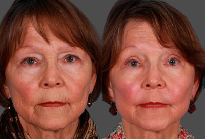 Eyelid Surgery (Blepharoplasty) Before & After Gallery - Patient 115560 - Image 1