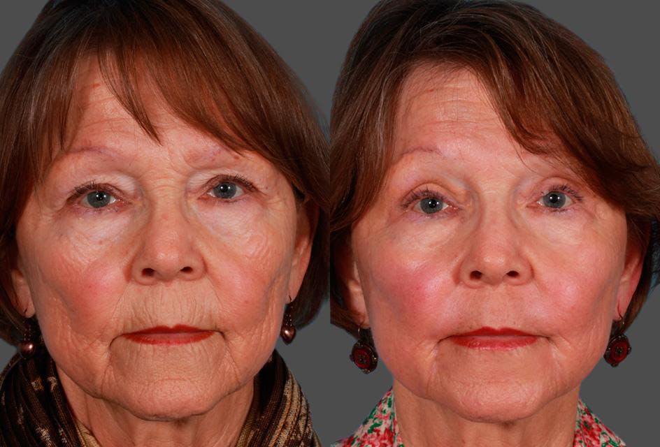 Eyelid Surgery (Blepharoplasty) Before & After Gallery - Patient 115560 - Image 1