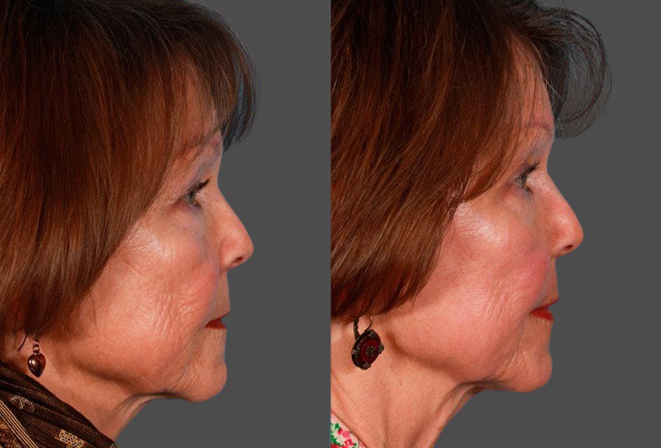 Eyelid Surgery (Blepharoplasty) Before & After Gallery - Patient 115560 - Image 3