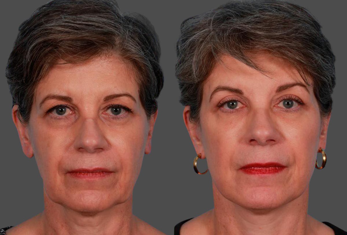 Limited Incision Facelift Before & After Gallery - Patient 255774 - Image 1