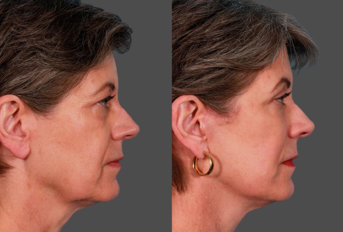 Limited Incision Facelift Before & After Gallery - Patient 255774 - Image 2