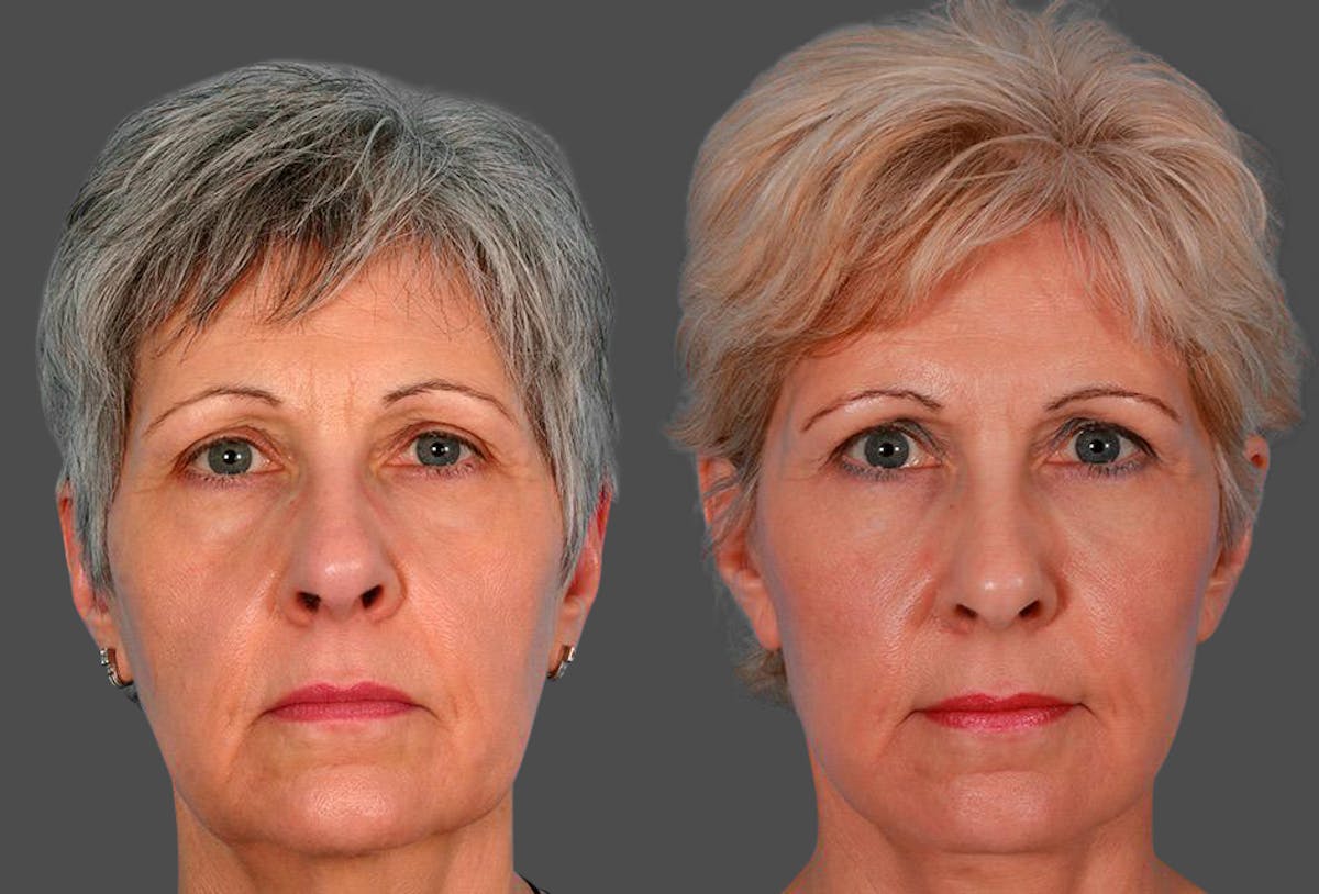 Eyelid Surgery (Blepharoplasty) Before & After Gallery - Patient 196256 - Image 1