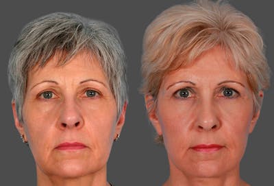 Eyelid Surgery (Blepharoplasty) Before & After Gallery - Patient 196256 - Image 1