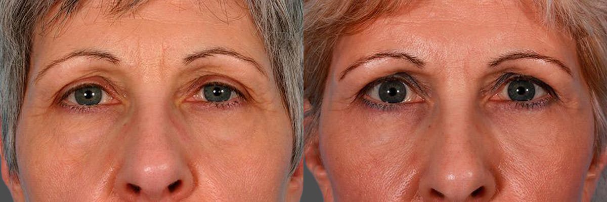 Eyelid Surgery (Blepharoplasty) Before & After Gallery - Patient 196256 - Image 4