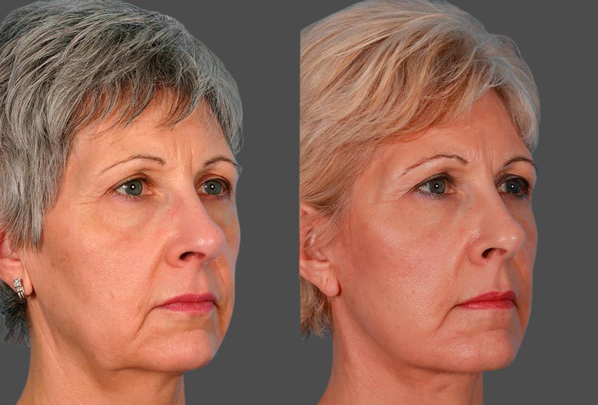 Eyelid Surgery (Blepharoplasty) Before & After Gallery - Patient 196256 - Image 2