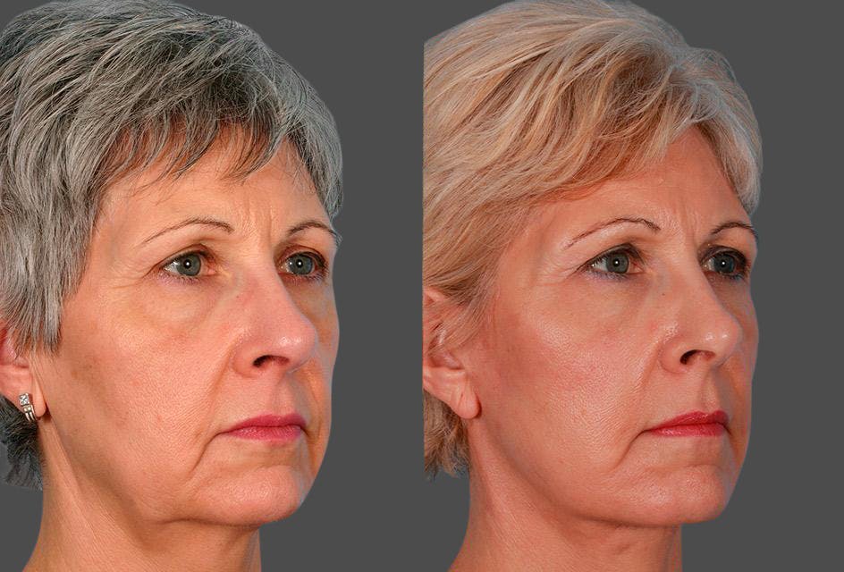 Eyelid Surgery (Blepharoplasty) Before & After Gallery - Patient 196256 - Image 2