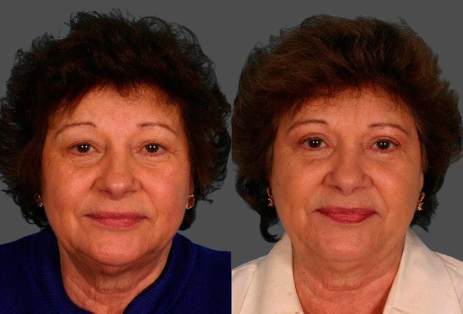 Eyelid Surgery (Blepharoplasty) Before & After Gallery - Patient 194674 - Image 1