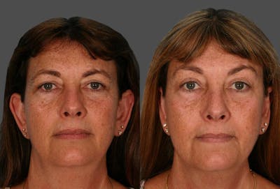 Eyelid Surgery (Blepharoplasty) Before & After Gallery - Patient 187940 - Image 1