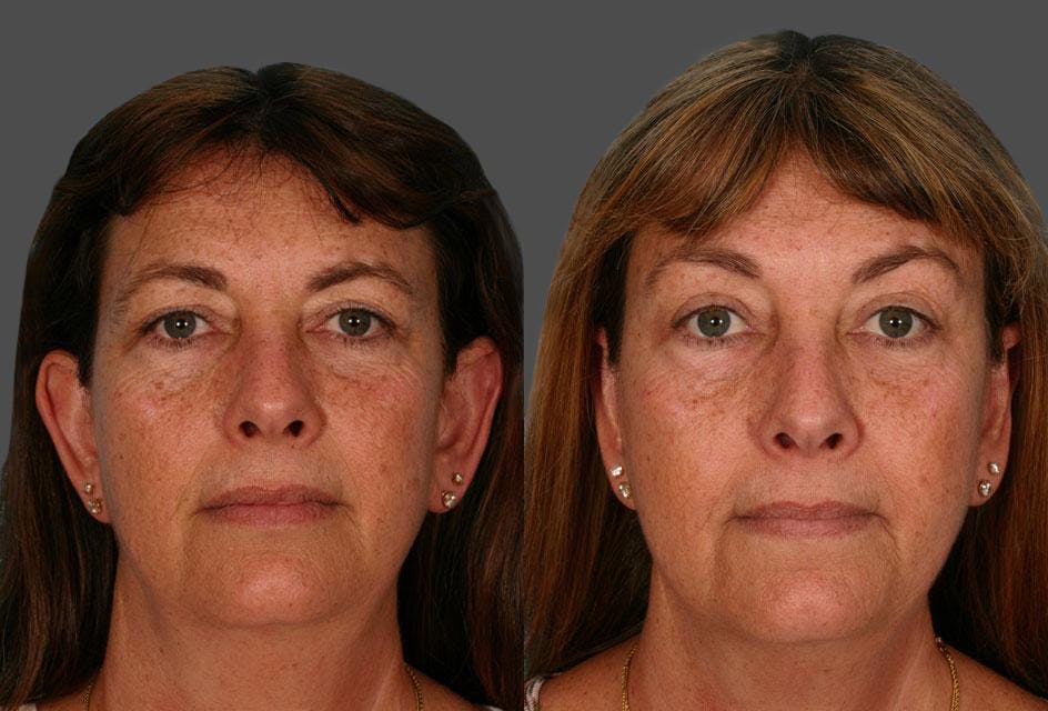 Eyelid Surgery (Blepharoplasty) Before & After Gallery - Patient 187940 - Image 1