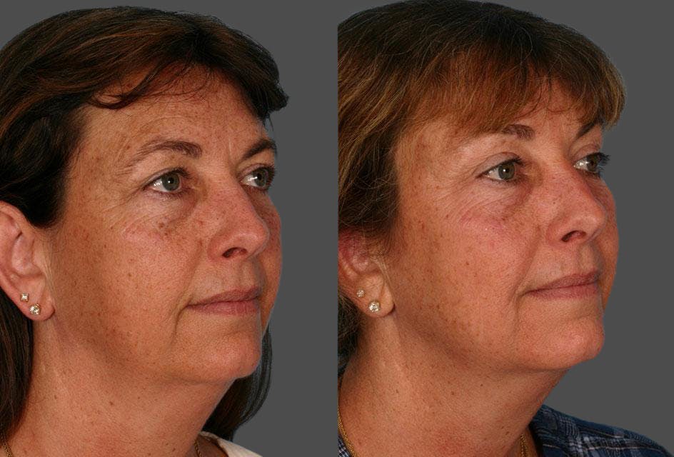 Eyelid Surgery (Blepharoplasty) Before & After Gallery - Patient 187940 - Image 2