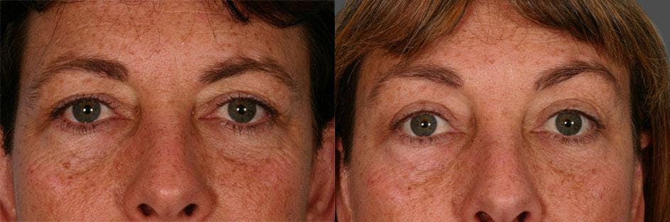 Eyelid Surgery (Blepharoplasty) Before & After Gallery - Patient 187940 - Image 3