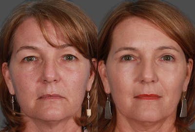 Eyelid Surgery (Blepharoplasty) Before & After Gallery - Patient 237934 - Image 1
