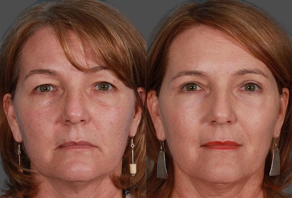 TCA Peel / Dermabrasion Before & After Gallery - Patient 188182 - Image 1