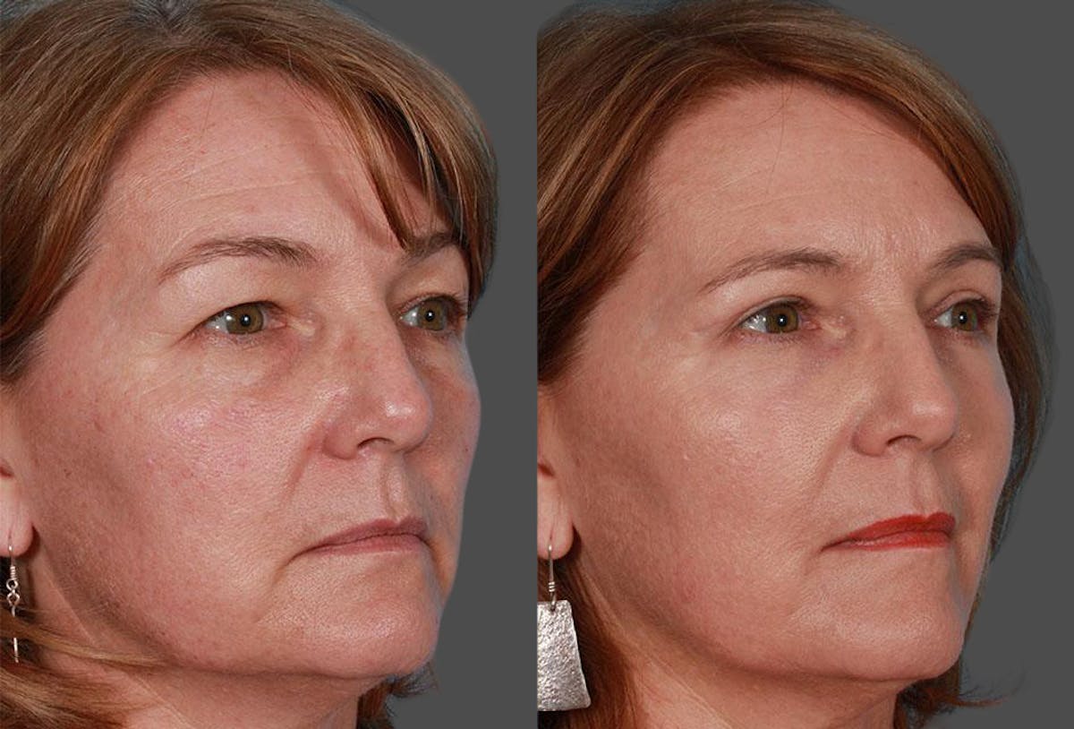 TCA Peel / Dermabrasion Before & After Gallery - Patient 188182 - Image 2