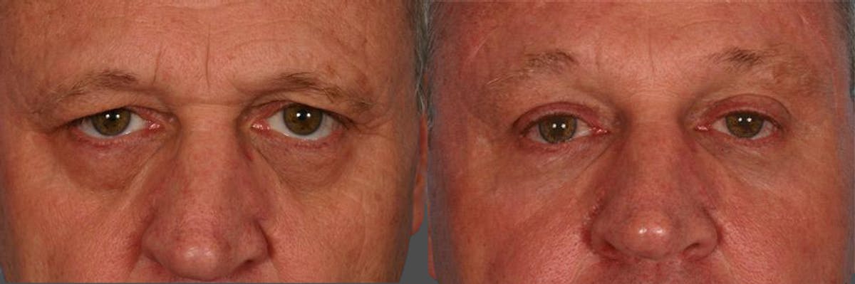 Eyelid Surgery (Blepharoplasty) Before & After Gallery - Patient 237902 - Image 1