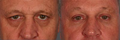 Eyelid Surgery (Blepharoplasty) Before & After Gallery - Patient 237902 - Image 1