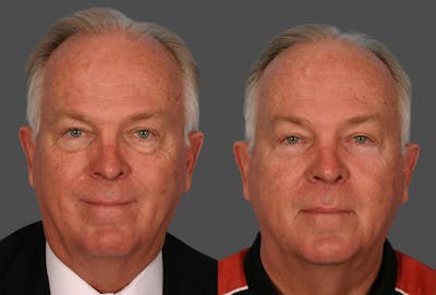 Eyelid Surgery (Blepharoplasty) Before & After Gallery - Patient 214588 - Image 1