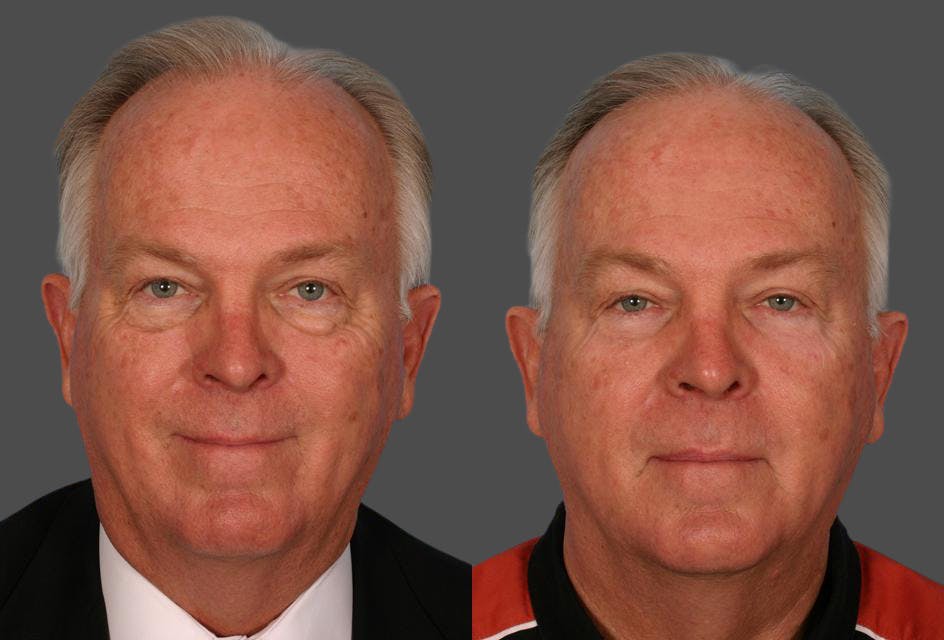 Eyelid Surgery (Blepharoplasty) Before & After Gallery - Patient 214588 - Image 1