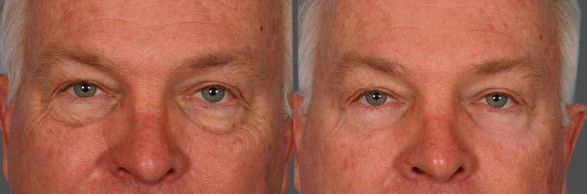 Eyelid Surgery (Blepharoplasty) Before & After Gallery - Patient 214588 - Image 2