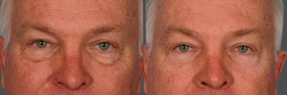 Eyelid Surgery (Blepharoplasty) Before & After Gallery - Patient 214588 - Image 2