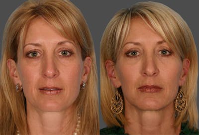Eyelid Surgery (Blepharoplasty) Before & After Gallery - Patient 214250 - Image 1