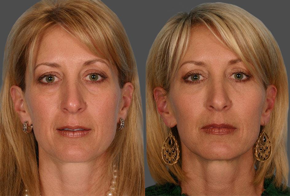 Eyelid Surgery (Blepharoplasty) Before & After Gallery - Patient 214250 - Image 1