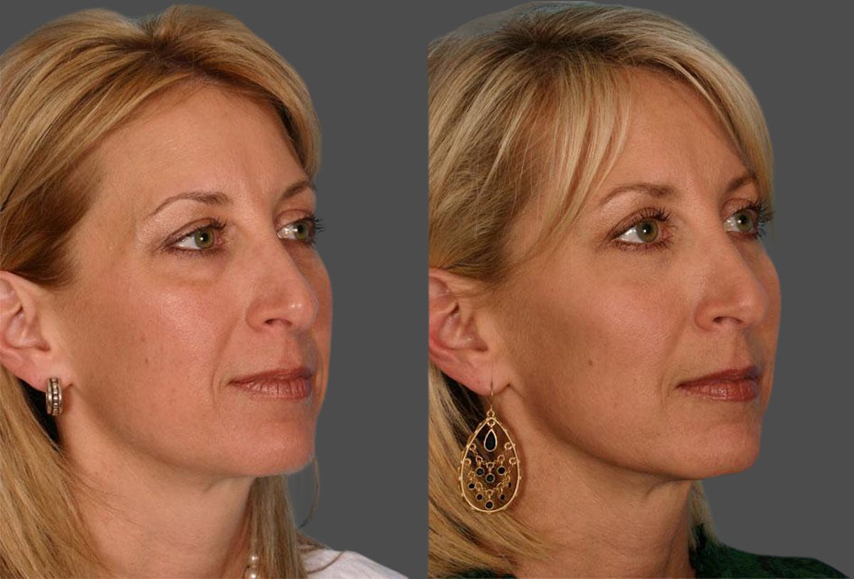 Eyelid Surgery (Blepharoplasty) Before & After Gallery - Patient 214250 - Image 2