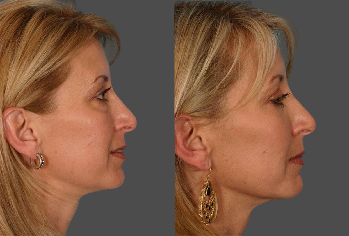 Eyelid Surgery (Blepharoplasty) Before & After Gallery - Patient 214250 - Image 3