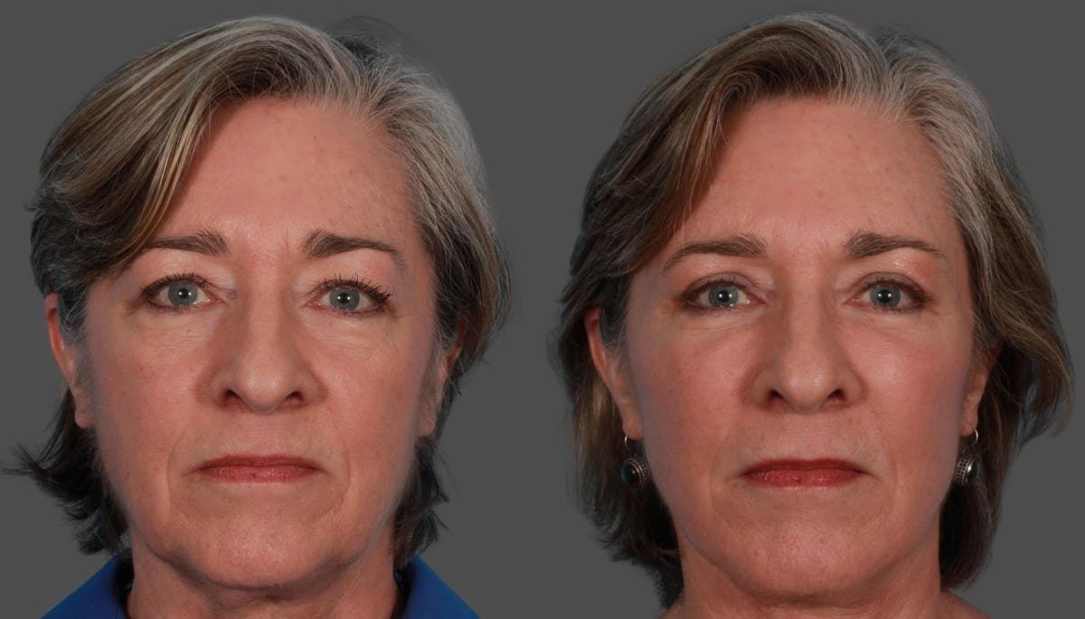Eyelid Surgery (Blepharoplasty) Before & After Gallery - Patient 279585 - Image 1