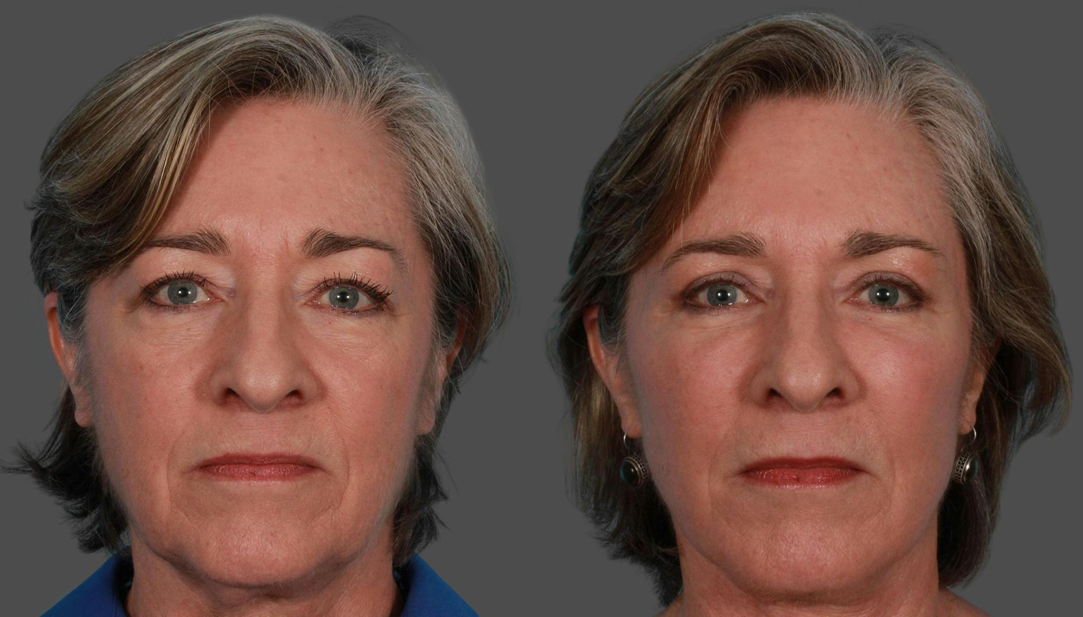 Eyelid Surgery (Blepharoplasty) Before & After Gallery - Patient 279585 - Image 1