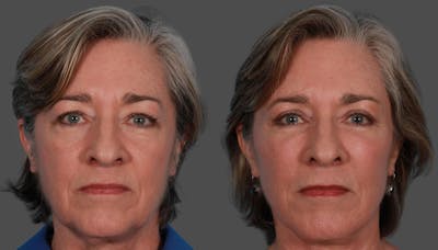 Eyelid Surgery (Blepharoplasty) Before & After Gallery - Patient 279585 - Image 1