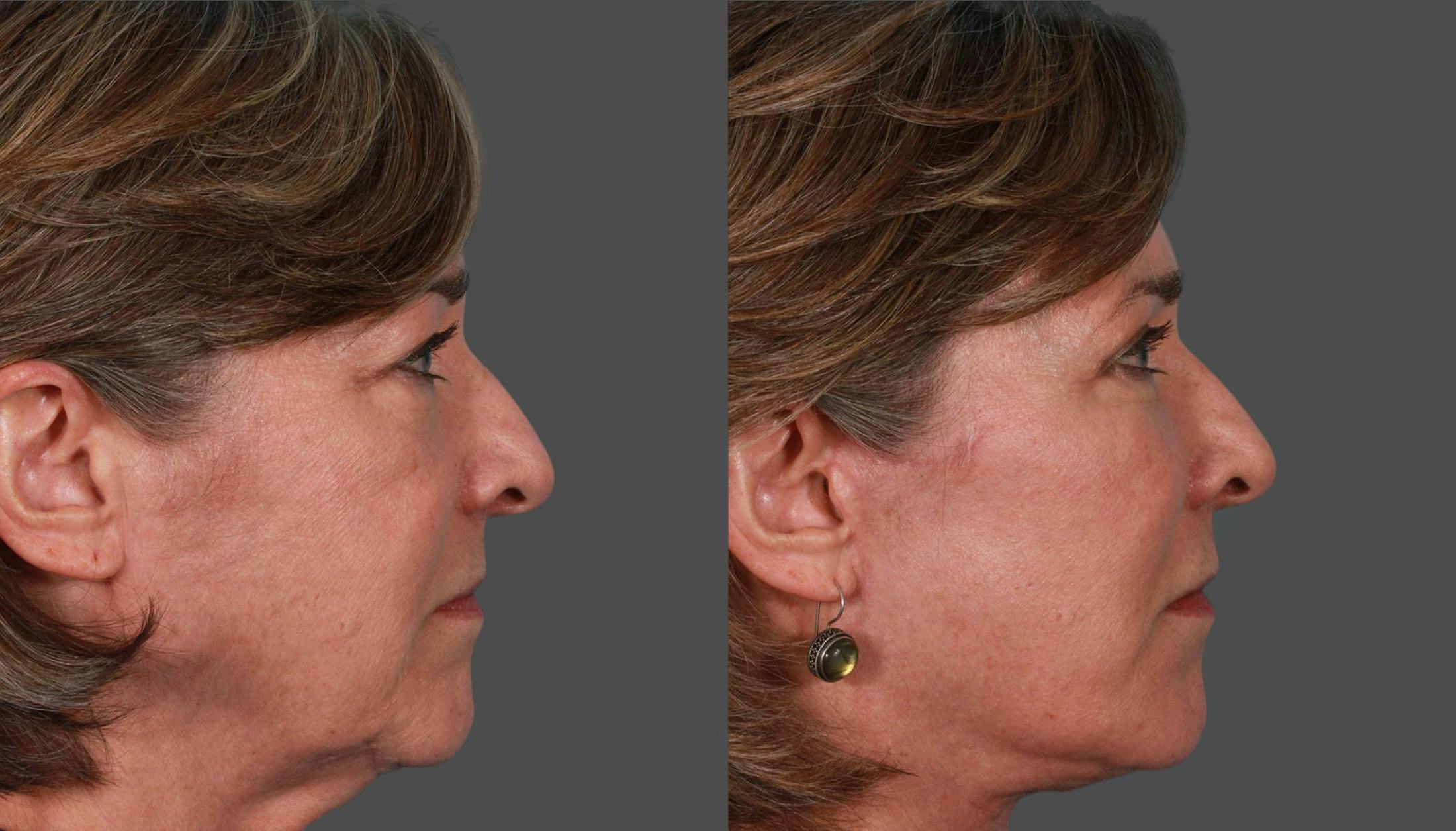 Eyelid Surgery (Blepharoplasty) Before & After Gallery - Patient 279585 - Image 2