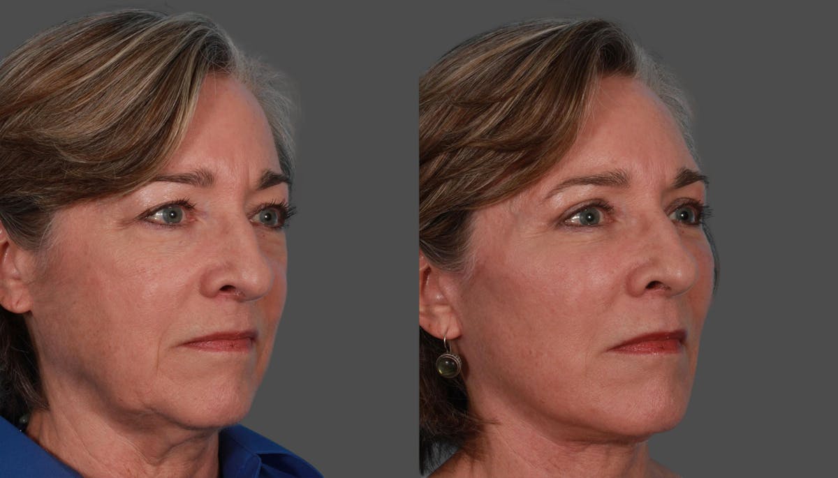 Eyelid Surgery (Blepharoplasty) Before & After Gallery - Patient 279585 - Image 3