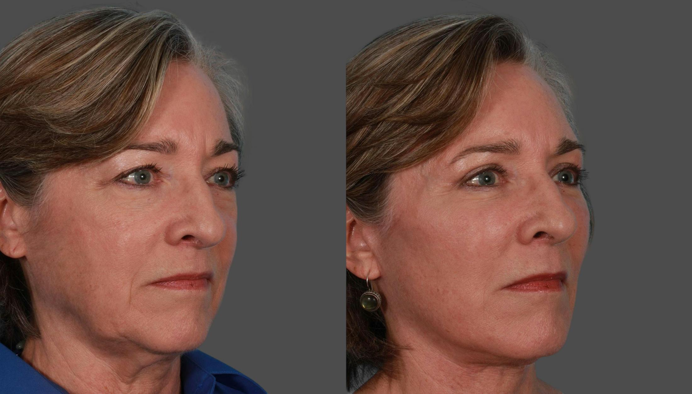 Eyelid Surgery (Blepharoplasty) Before & After Gallery - Patient 279585 - Image 3