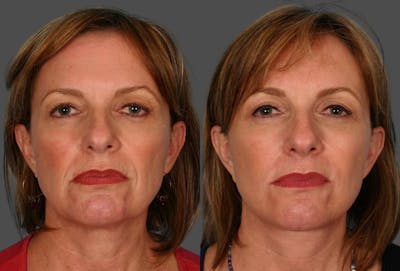 Eyelid Surgery (Blepharoplasty) Before & After Gallery - Patient 250574 - Image 1