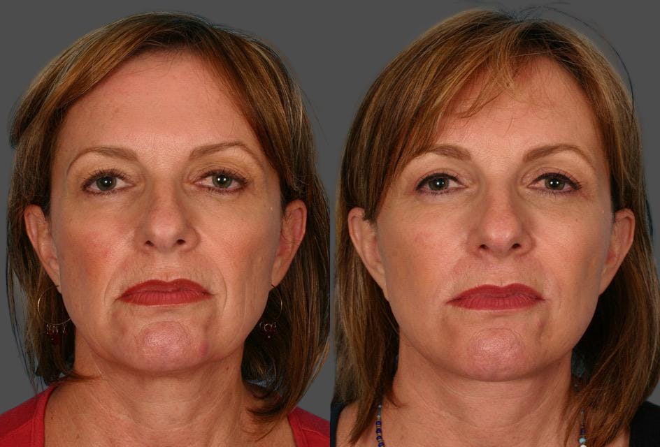 Eyelid Surgery (Blepharoplasty) Before & After Gallery - Patient 250574 - Image 1