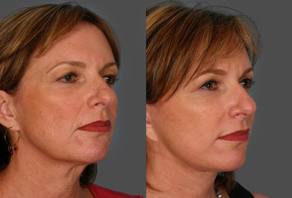 Eyelid Surgery (Blepharoplasty) Before & After Gallery - Patient 250574 - Image 2
