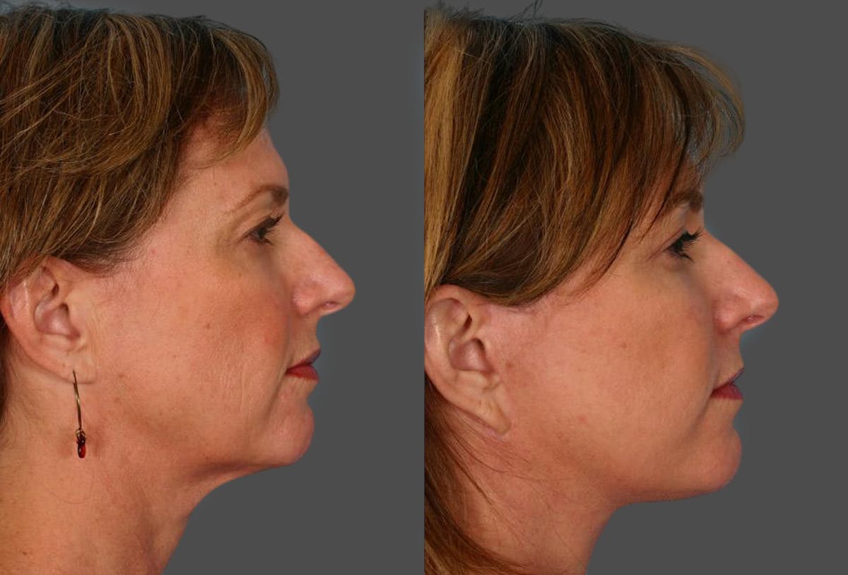 Eyelid Surgery (Blepharoplasty) Before & After Gallery - Patient 250574 - Image 3