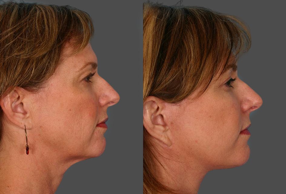 Eyelid Surgery (Blepharoplasty) Before & After Gallery - Patient 250574 - Image 3