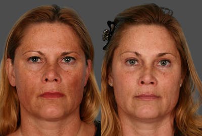 Eyelid Surgery (Blepharoplasty) Before & After Gallery - Patient 244078 - Image 1